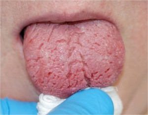 Note the extensive fissuring and loss of filiform papillae. The velvety fungiform papillae are preserved.  These changes are characteristic of patients with long-standing salivary hypofunction.